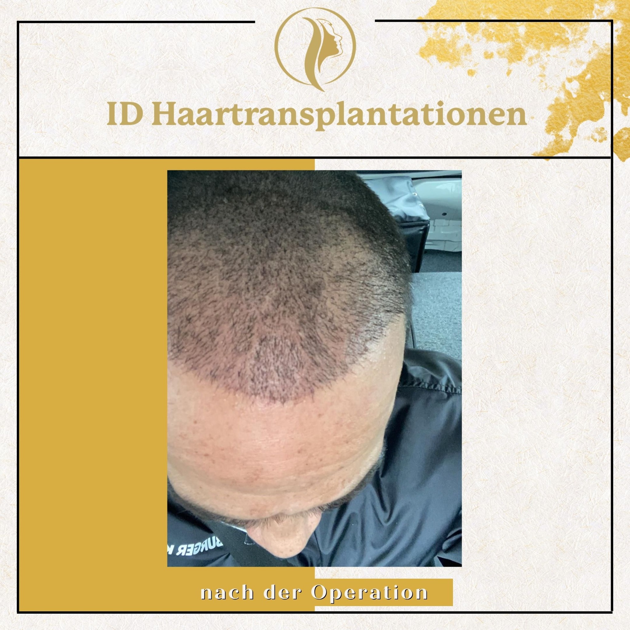 Haartransplantation Mannheim