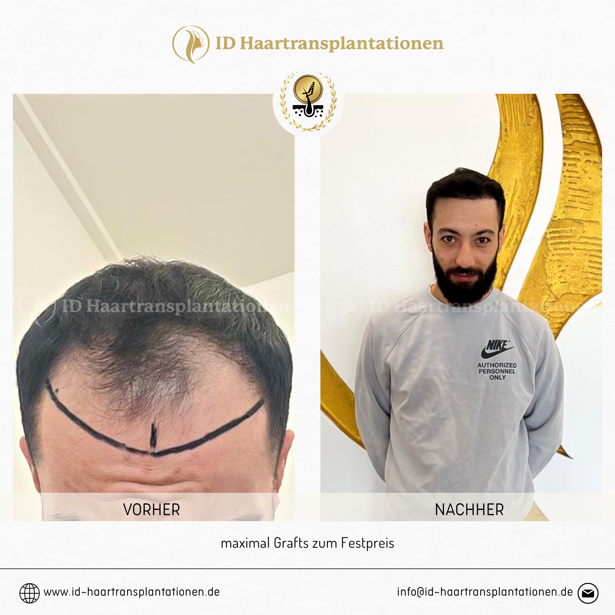 Haartransplantation Mannheim