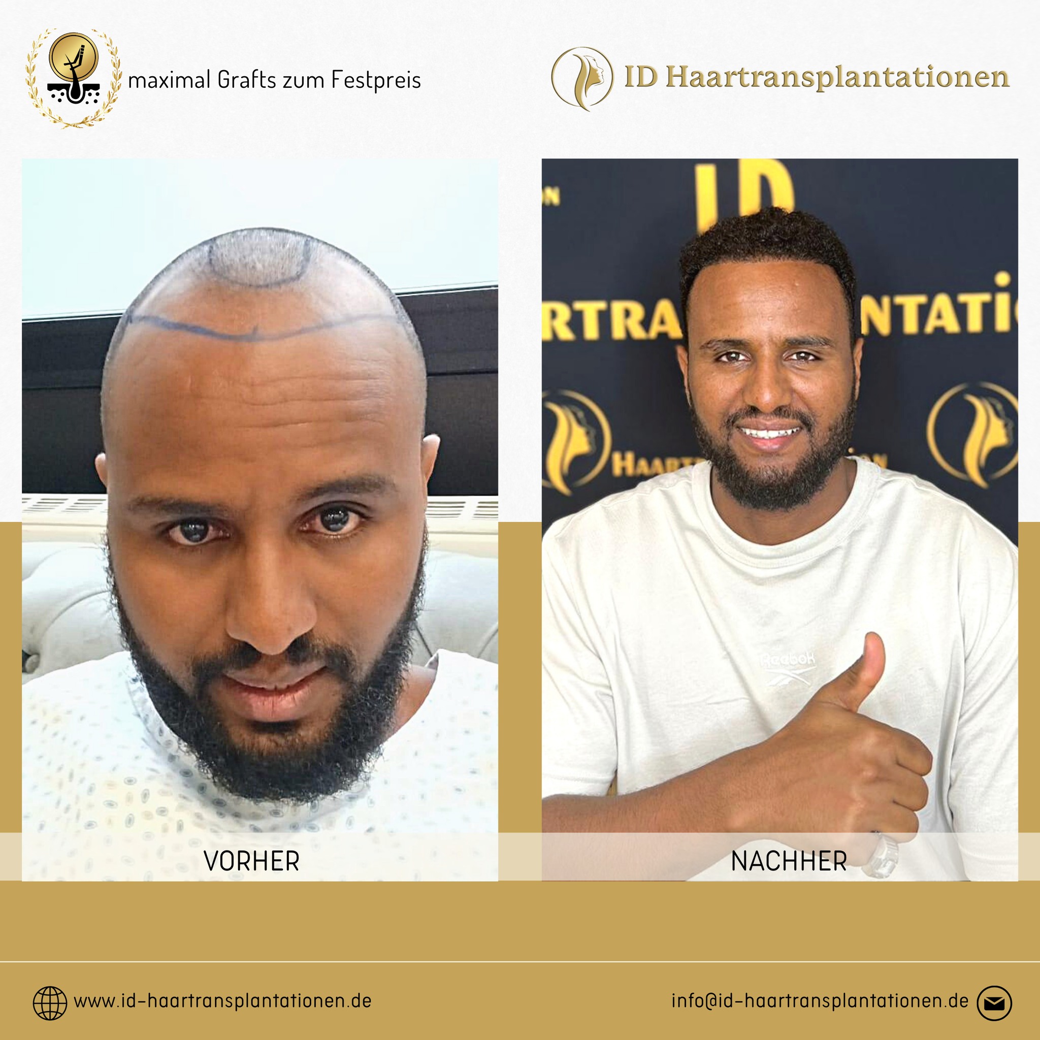 Bilder Nach Haartransplantation