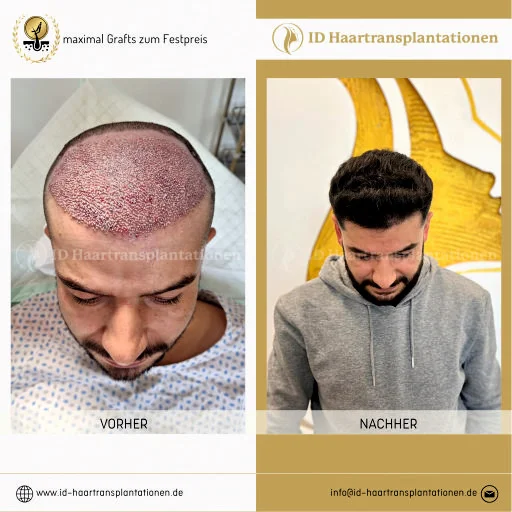 Hair transplantation Mannheim
