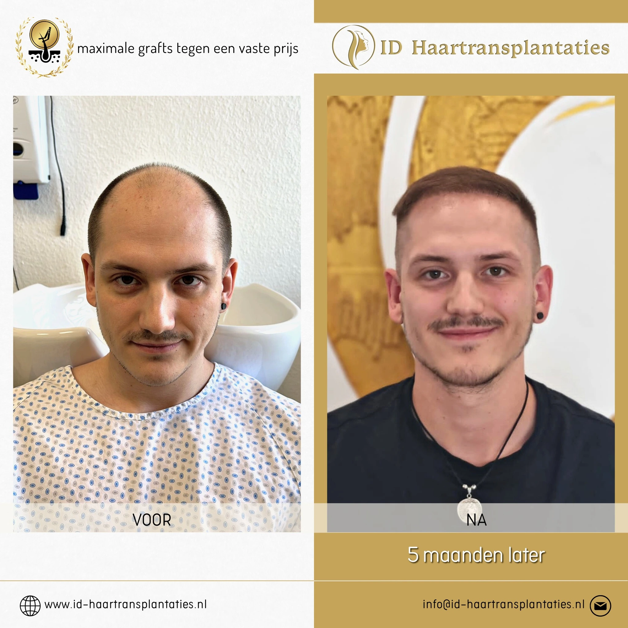 ID HAARTRANSPLANTATIONEN