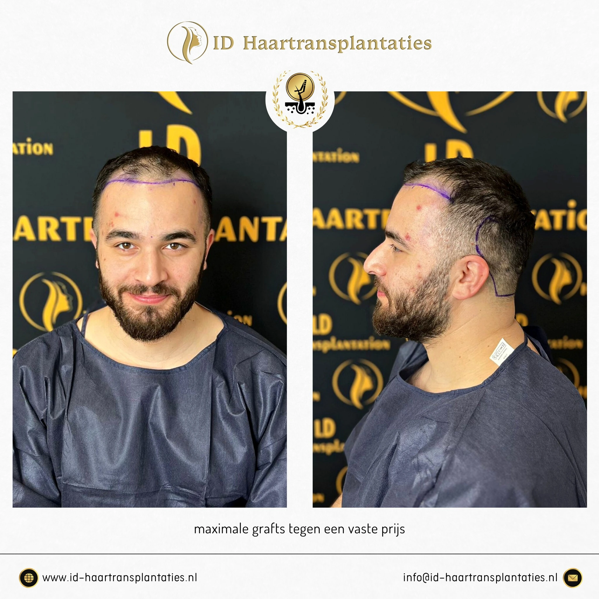 ID HAARTRANSPLANTATIONEN